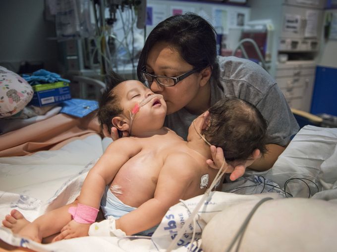 Nauwkeurig Kust Preventie Conjoined twins nearing date for separation surgery | cbs19.tv