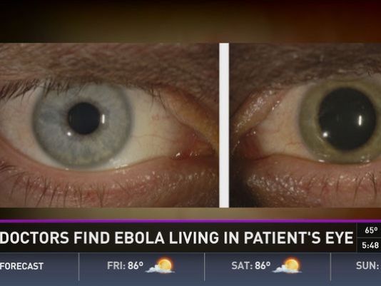 Ebola Virus Patients Eyes Why A Perfect Ebola Storm Has Started?
